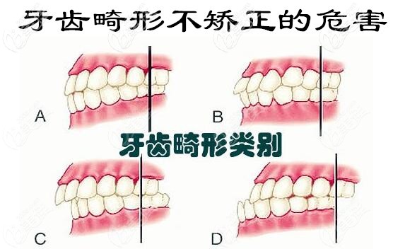 牙齿畸形不矫正的危害