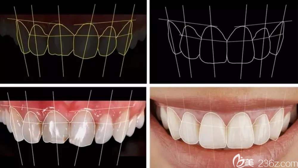 牙齿瓷贴面效果图