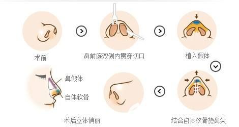 罗院长做鼻综合整形的手术步骤简易图