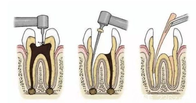 郑彦鹏告诉你：如果做了根管治疗之后，坚决不做牙套有没有影响