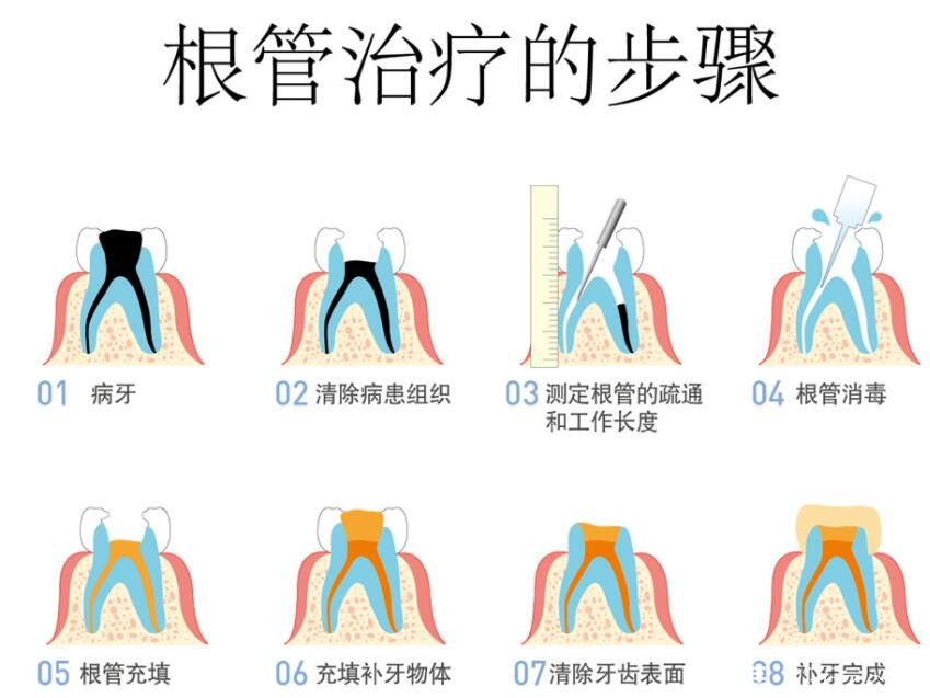 郑州德正口腔高俊杰医生介绍根管治疗