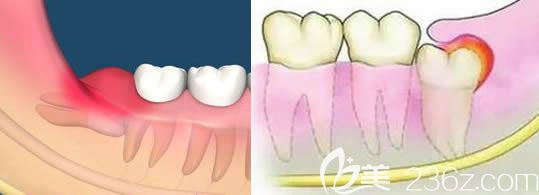 王冠一医生讲解什么样的智齿需要拔除