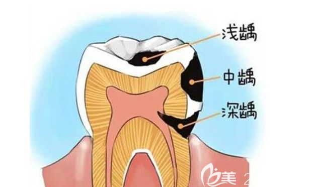 邱承林.医生建议应该种植牙齿预防