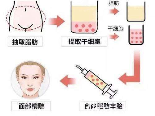 王院长采用自体脂肪填充改善面部凹陷的手术原理图