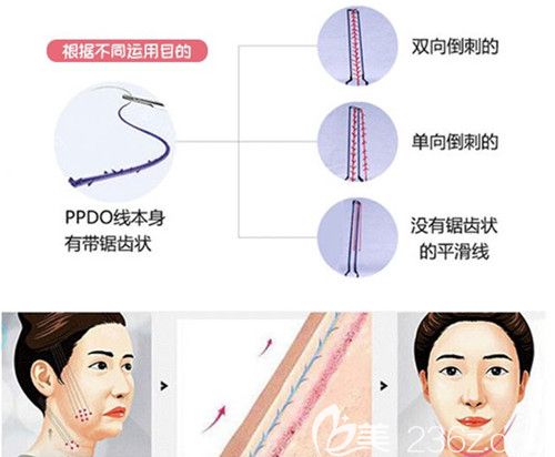 崔丽医生讲解埋线提升作用原理