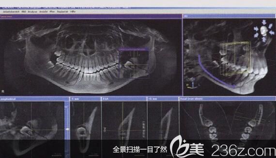 洛阳九龙口腔刘孟厚医生介绍什么是微创种植牙