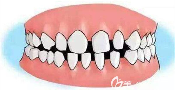 牙齿牙缝过大可以通过贴面或矫正来处理