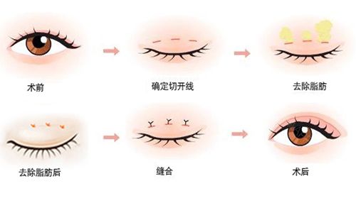 万主任做芭比电眼双眼皮手术步骤示意图