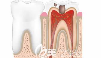王入义医生科普牙髓炎知识