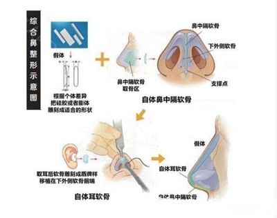 陆医生做鼻综合整形手术步骤简易图