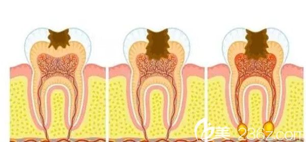 引发牙髓炎症的主要原因
