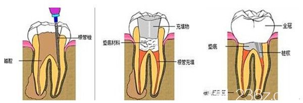 根管治疗流程图