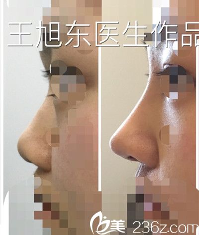 王旭东医生隆鼻手术案例