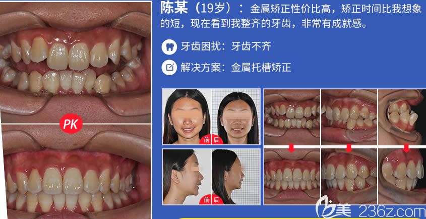 广州圣贝口腔武玉海主任牙齿正畸案例图