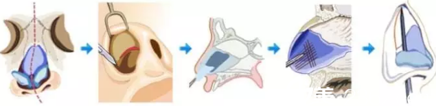 隆鼻手术过程