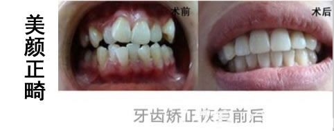 北京圣贝口腔医院刘雪莲成人隐形牙齿矫正案例