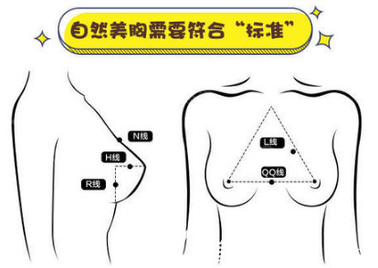 佛山苏李秀英杨智伟隆胸标准