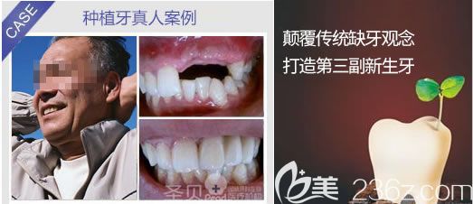 北京圣贝口腔霍平医生门牙缺失种植修复前后比效果