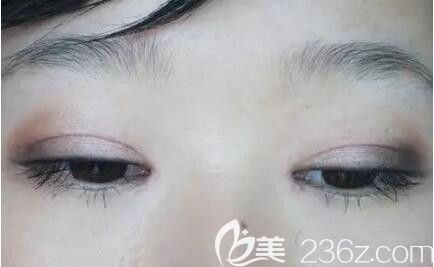 上海天大医疗美容医院宋丹洁切开双眼皮+开眼角真人案例术后照