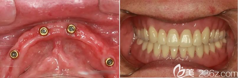 长沙利尔口腔谭政全口种植牙案例效果图