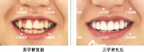 武汉贝蓓整形黄超牙齿矫正修复案例对比图