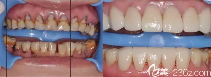 蔡菁菁医师树脂充填+全瓷冠修复案例效果对比图