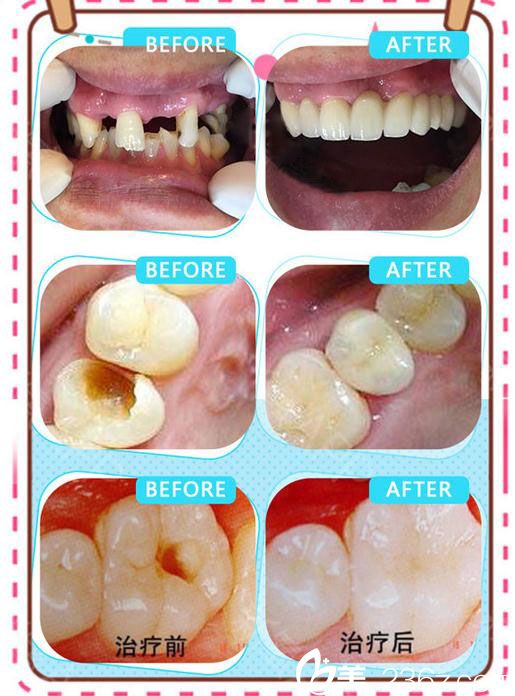 武汉至尚贝蓓医院陈康龋齿治疗案例