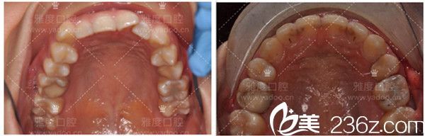 隐形矫正前后效果图