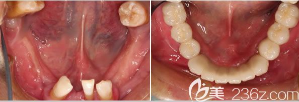 长沙利尔张鑫瑾医生多颗牙缺失种植案例效果图