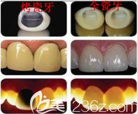 全瓷牙和烤瓷牙对比图