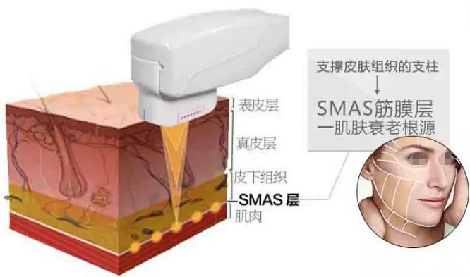 除皱原理