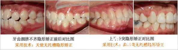 长沙利尔冯梅芳牙齿拥挤及上牙外突矫正对比效果