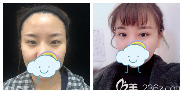 天津联合丽格朱晓峰医生双眼皮失败修复术后1个月对比图