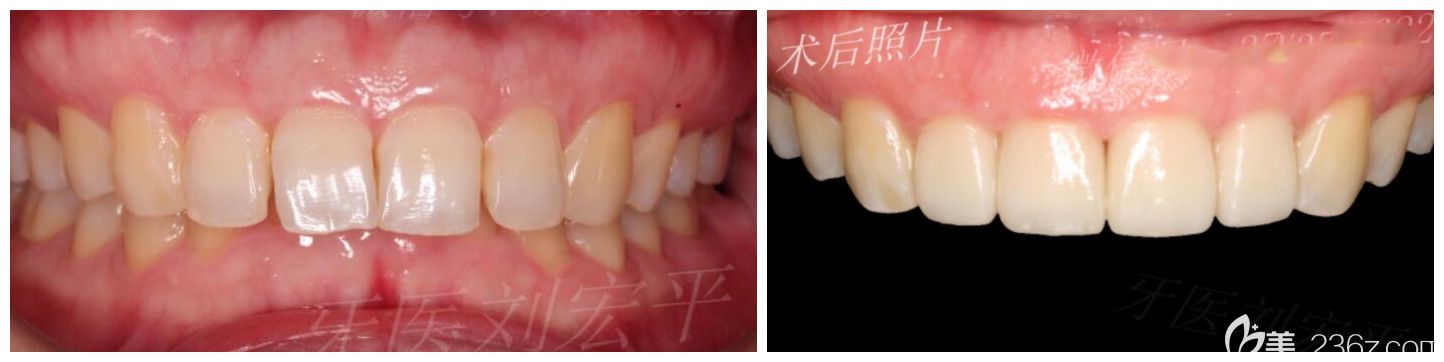 刘宏平25岁女性牙贴面修复牙齿案例