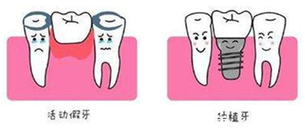 种植牙相较于活动假牙优势更大