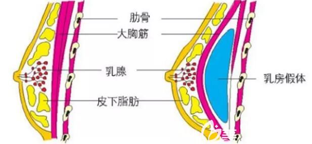 孙万林医生分享假体隆胸手术