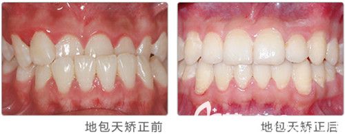 地包天矫正前后效果图