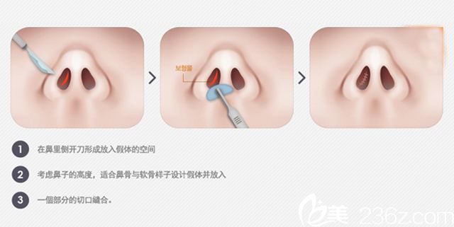 立体隆鼻术原理