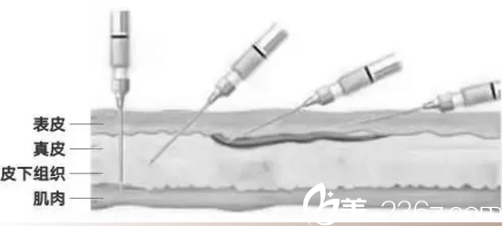 定点角度注射玻尿酸