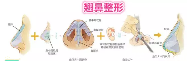 孙兰娟主任做达拉斯鼻综合手术原理