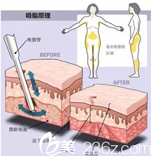 360°水动力吸脂原理