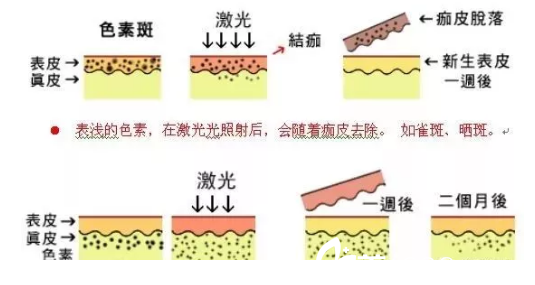 激光祛斑过程图