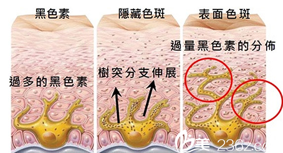 聊城美容整形医院色斑形成分析图