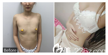 桂林时光美莱整形医院毛建文隆胸案例