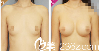 蒋斌医生微创隆胸前后对比图