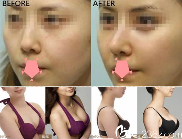 陈卫玲鼻综合隆鼻和假体隆胸案例