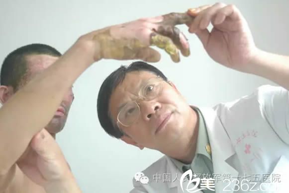 郑庆亦教授大面积烧伤治疗案例图