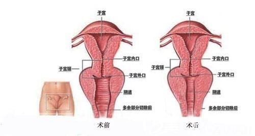 韩式微创阴道紧缩术原理