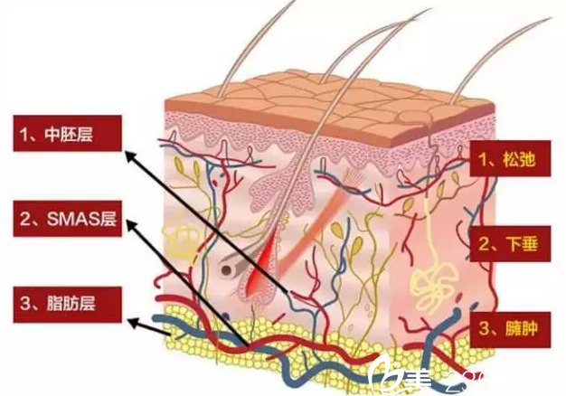 线雕提升除皱原理