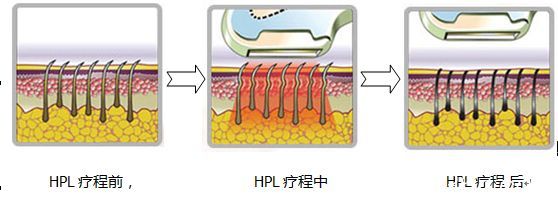 光子嫩肤治疗原理